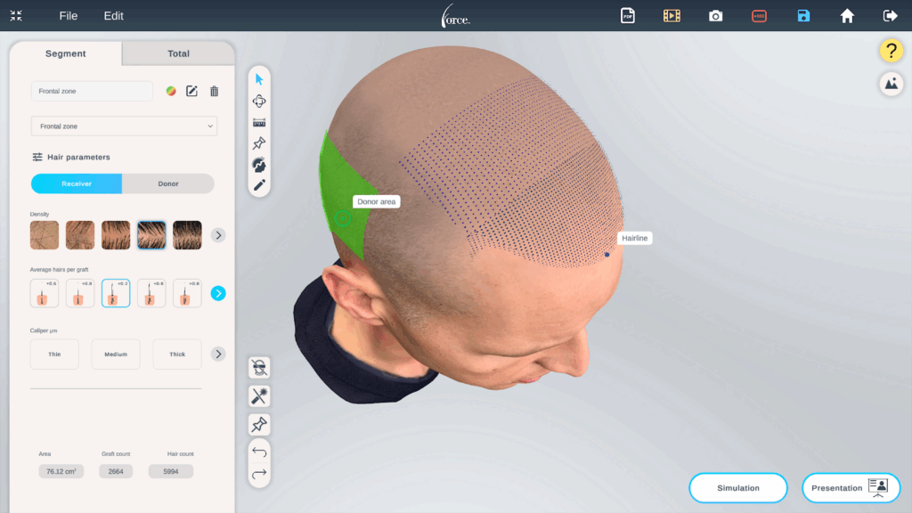 En skärmdump från ett verktyg som hjälper hårkliniker att visualisera processen med hårtransplantation.
